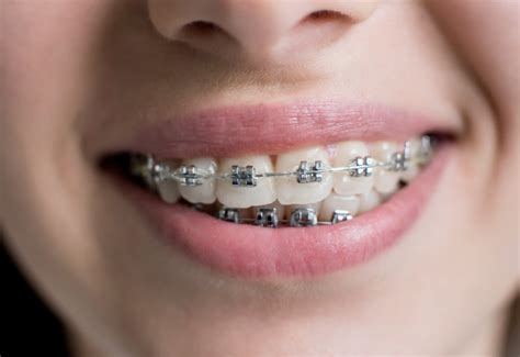 brackets metalicos precio|cuanto cuestan los brackets.